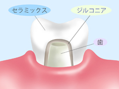 ［画像］ジルコニア