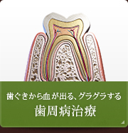 歯ぐきから血が出る、グラグラする 歯周病治療