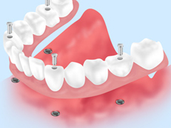 ［画像］インプラントオーバーデンチャー