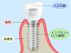 インプラント図解