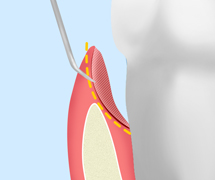 [画像]歯周ポケットそうは術