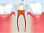 [画像]1.感染した歯の神経や細菌を除去　